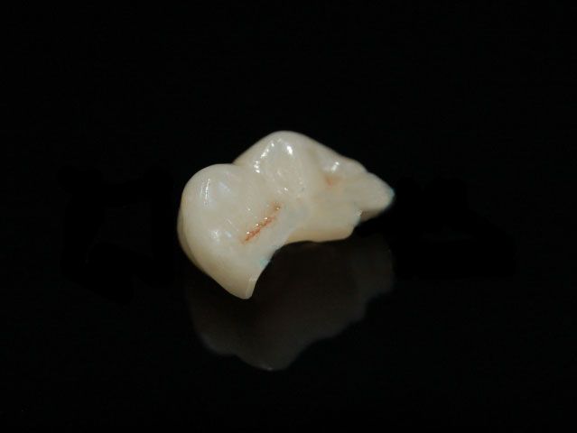 Denture (Metal-Free,VITABLOCS Onlay)