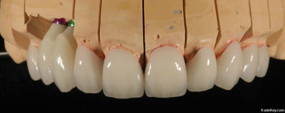 E.max, all porcelain crowns, Implant