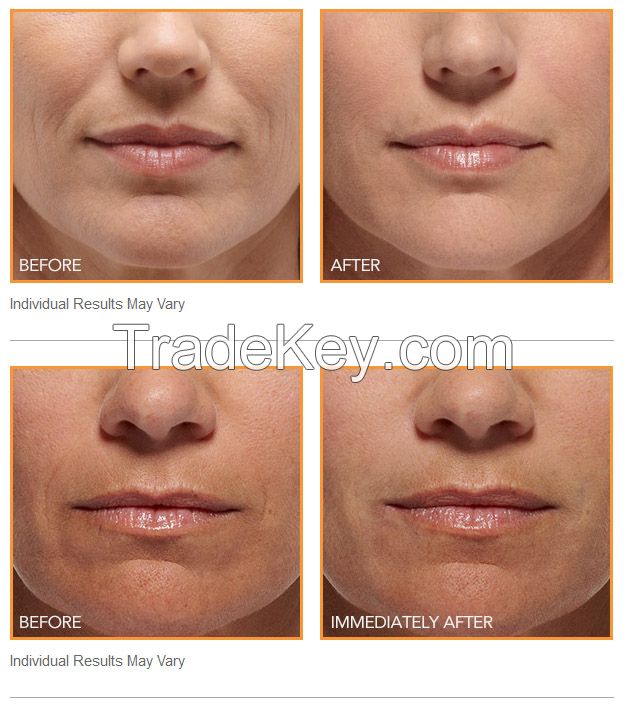buy injectable dermal fillers