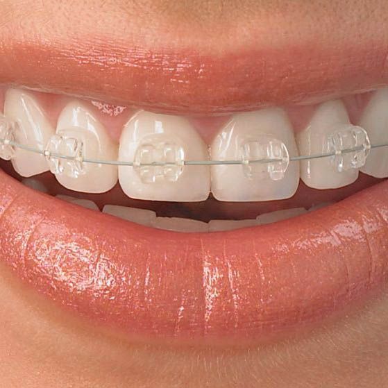 Orthodontic Ceramic bracket