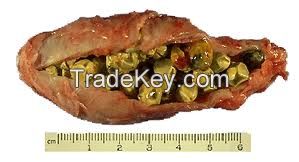 Gallstones