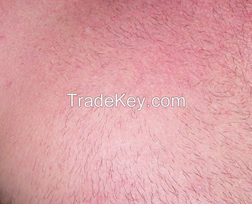 The Xemos Laser Permanent Hair Removal System for home use