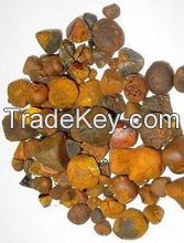 Gallstone