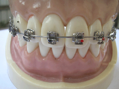 orthodontic self-ligation bracket