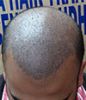 Hair Transplant for Ma...