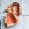 removable denture, den...