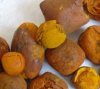 Gallstone