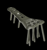 Orthopedic implant ( Locking plate ) { dedania AT gmail DOT com }