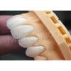 Dental restoration