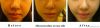 Medical facial lifting...