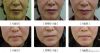 Medical facial lifting...