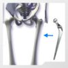 Hip Prothesis