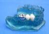 removeable denture