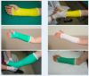 orthopedic casting tap...