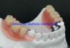 Dental acrylic denture