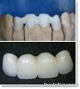 Dental zircon PFM porc...