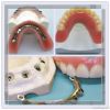 Bar Overdenture on Imp...