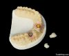 Dental Implant Prosthe...