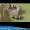 Dental Implant Crowns
