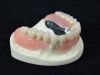 Removable Denture (Tel...