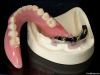 Denture (Implant Bar O...