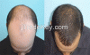 Hair Transplant in Dubai