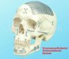 Titanium Osteosythesis...