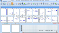 Beneware CardioTrak Holter Analysis Software World First AF Automatic Analysis