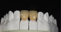 Porcelain Fused to Metal Crown&amp;Bridge