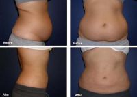 Laser LIipolysis For Belly Fat Removal