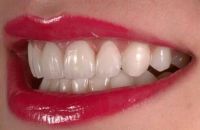 dental emax veneer ips veneer full ceramic veneer