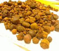 Gall Stones