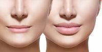 Dermal Filler, Dermal Fillers