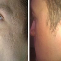 Beauty salon equipment rf microneedling fractional skin tightening device for acne and stretch mark From China