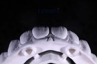 Titanium Alloy Malo Bridge restoration Biocompatibility + Personalized Design, Perfect Match with Alveolar Bone Structure From China