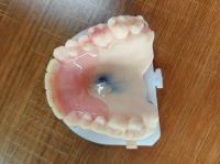 Valplast denture From Others1