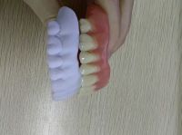 Acrylic denture, Full acrylic denture