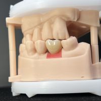 Implant crown with screw retained