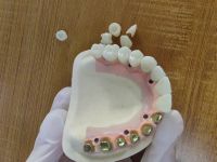 Titanium Malo bridge with zirconia crowns