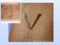 DISPOSABLE DEVICE FOR MESOTHERAPY and Acupuncture/*Mesopuncture From France