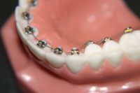 STB Lingual Brackets