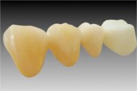 PFM Denture Teeth