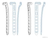 Implants for traumatology - Proximal tibial plates angularly stable