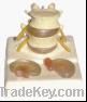 The central and lateral disc herniation model