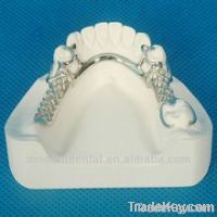 framework/metal denture