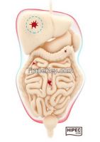 HIPEC system